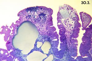 Whipple disease - cured(semithin section)